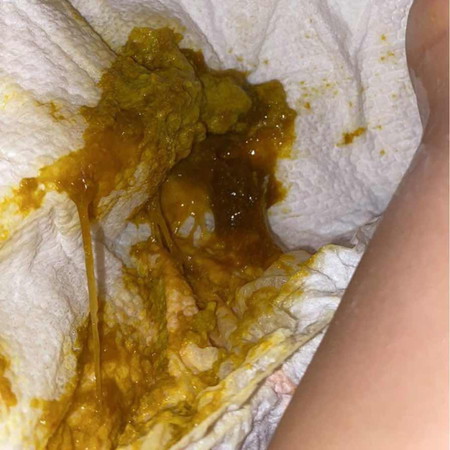 parang sipon ang poop ni baby