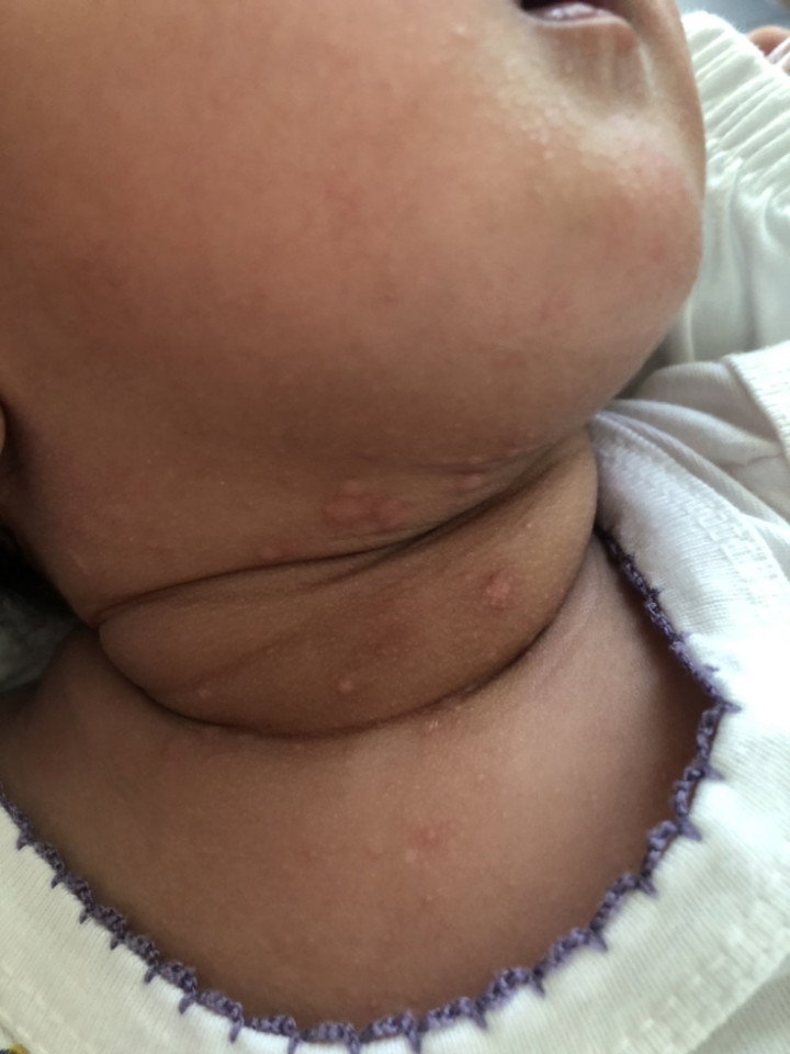 BUTLIG AT RASHES SA LEEG AT BATOK PATI MUKHA NI BABY