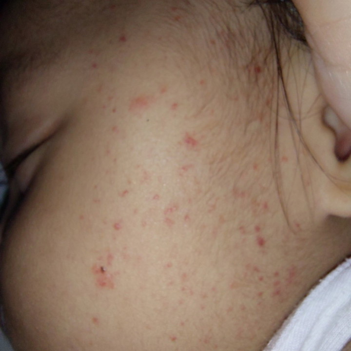 Mga mi, rashes po kaya itong nasa mukha ni LO? What to do po