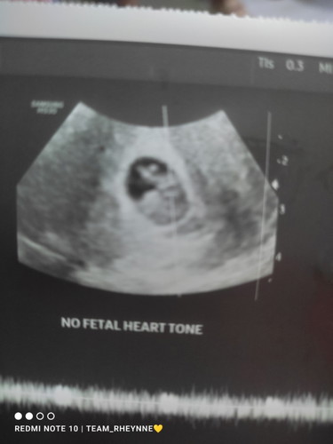 No heart beat tone