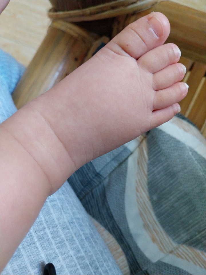 baby swollen foot