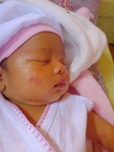 Mga momshies pahelp naman Po paano ba mawala Ang rashes SA face Ni baby? 10 days old palang si baby.