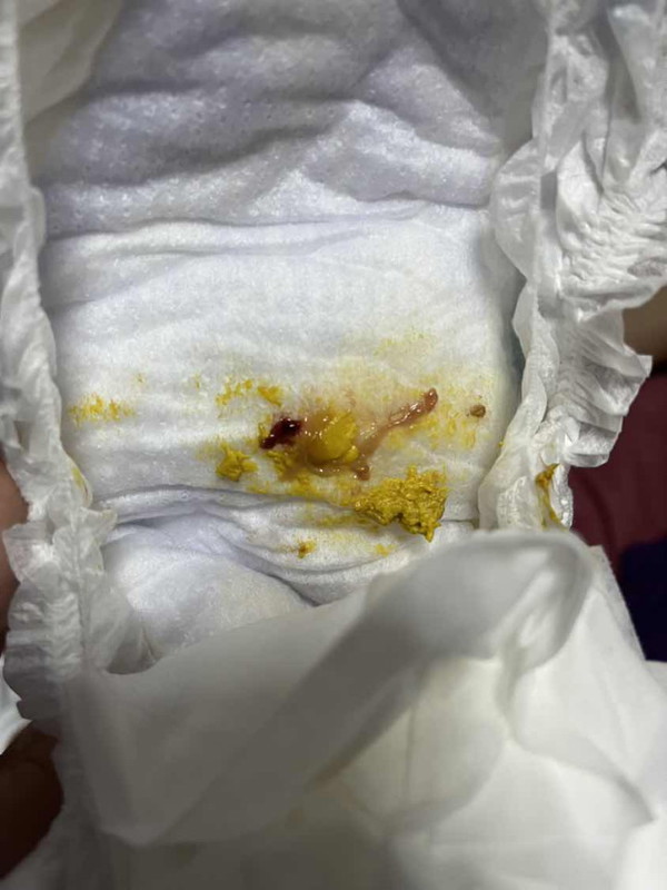 Newborn poop with tinge of blood My LO is 15 days old today