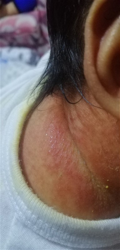 Gamot for rashes Mga momsh, any recommendations po sa effect