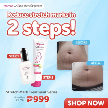 With only 2 STEPS, You Can Say Goodbye to Stretch Marks! 😍