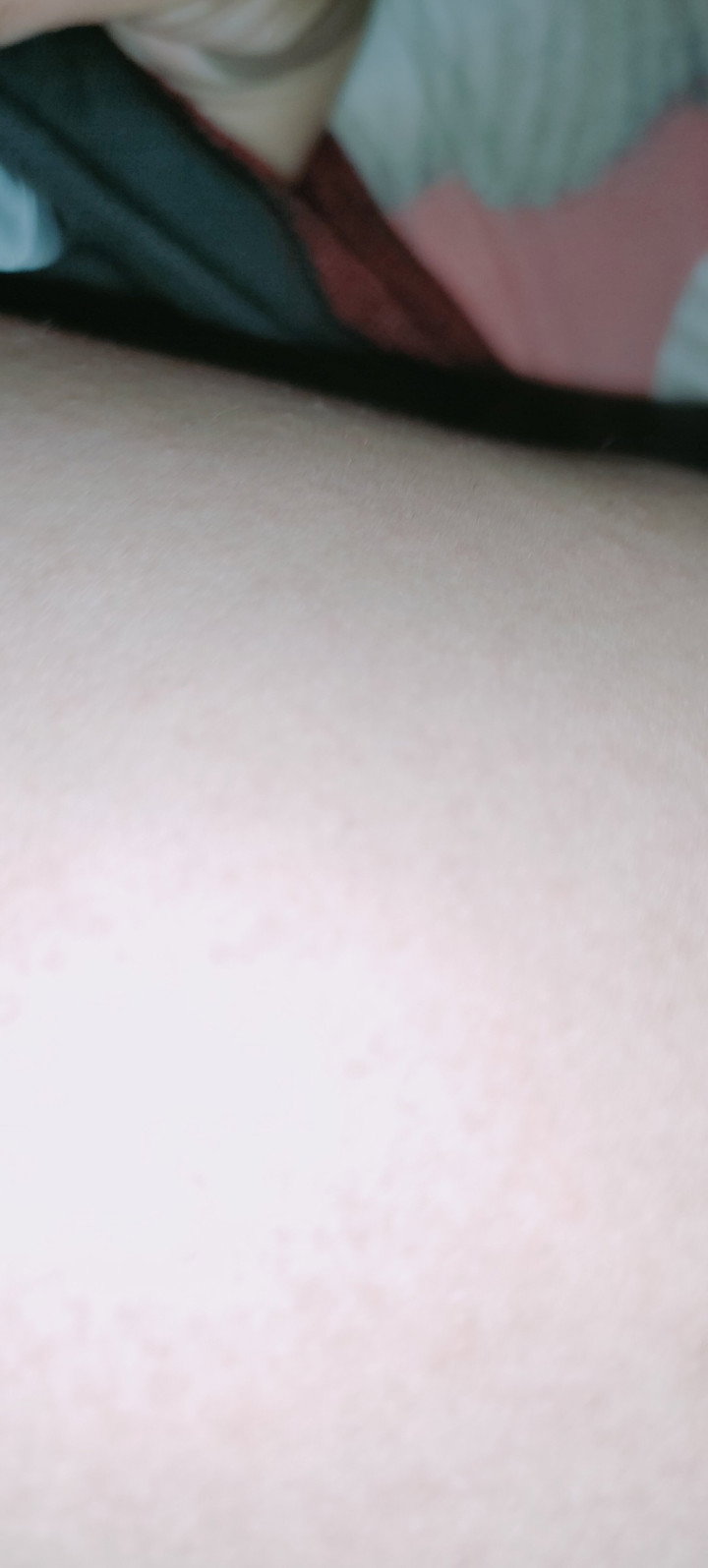 Rashes sa katawan ni baby.
