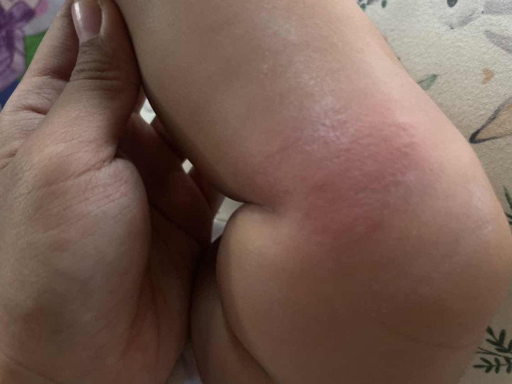 มีผื่นแบบนี้ขึ้นที่ขา