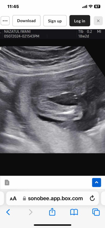 Ada chance tak baby boy Masa 18w2d scan 2D sonographer kata