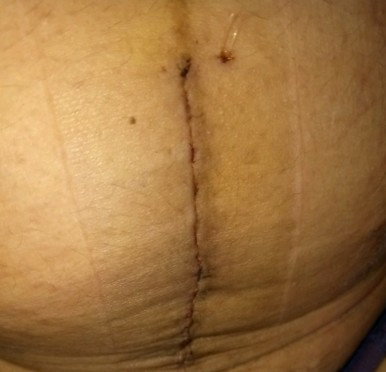 Post op E-CS
