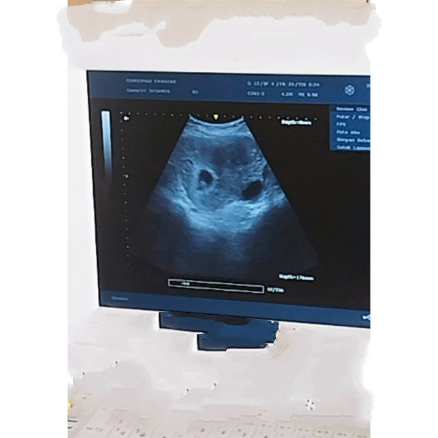 Acnormal Usg Week poto USG saya, pada saat usia kandungan 7 week,disitu ada 2