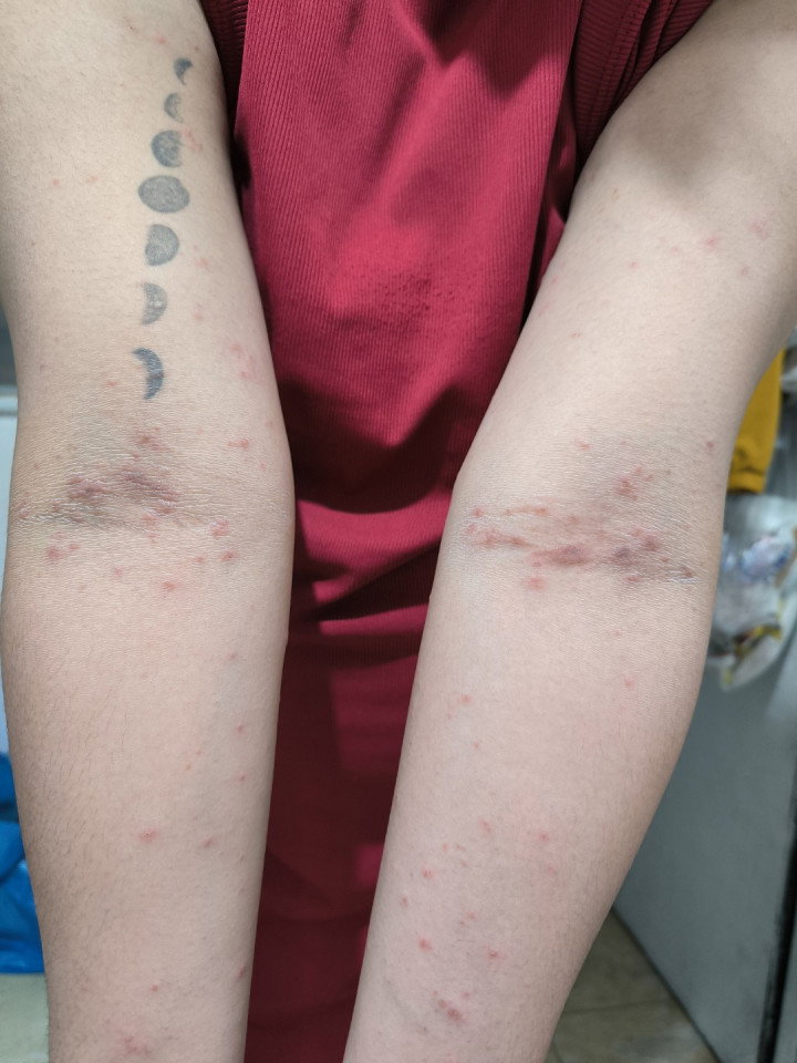 Skin Rashes Normal ba to na skin rashes sa buntis? Dalawang