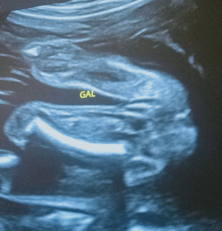 Boy or girl