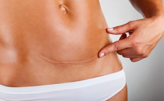 Tahukah anda yang anda masih boleh bersalin normal walaupun pernah membuat pembedahan secara Caesarean?