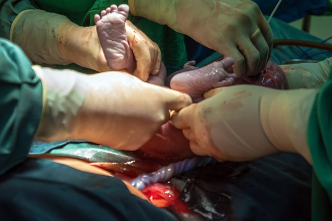 Lebih ramai ibu-ibu di seluruh dunia lebih cenderung memilih untuk bersalin dengan kaedah Caesarean