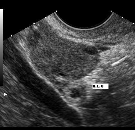 Is it possible to get pregnant with 1 ovary?