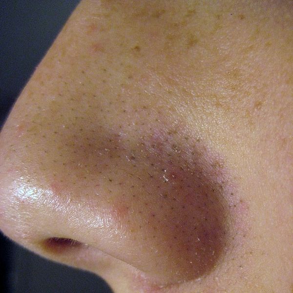 Say Goodbye To Ugly Blackheads