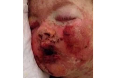 Stevens-Johnson Syndrome: Toddler almost dies from excruciating blisters on her face!