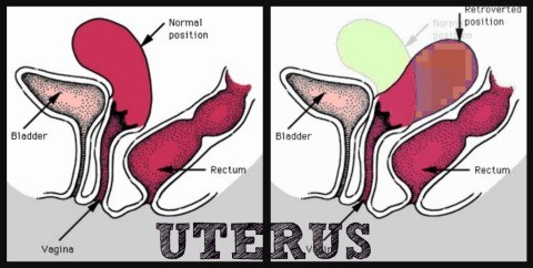 Retroverted Uterus Diagram Variants Uterine Position Stock, 40% OFF