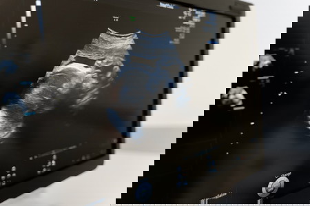ectopic pregnancy