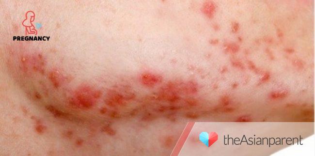 Rosacea during pregnancy: What it is and how can you treat it