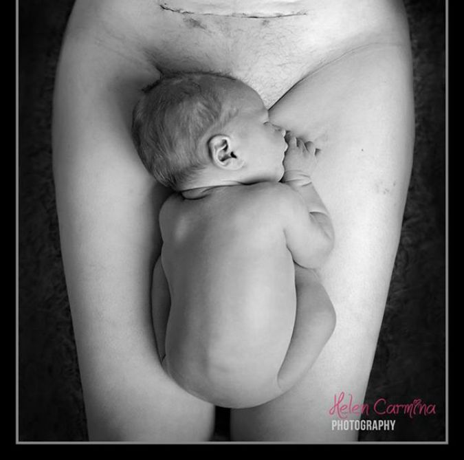 The powerful C-section scar photo that got the world talking