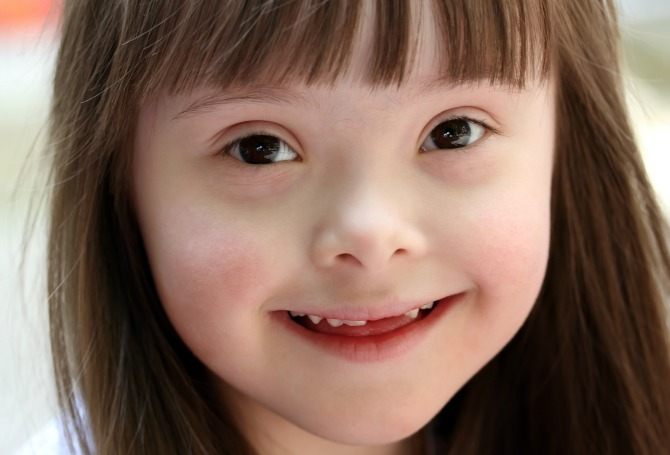 What you should know about Down syndrome