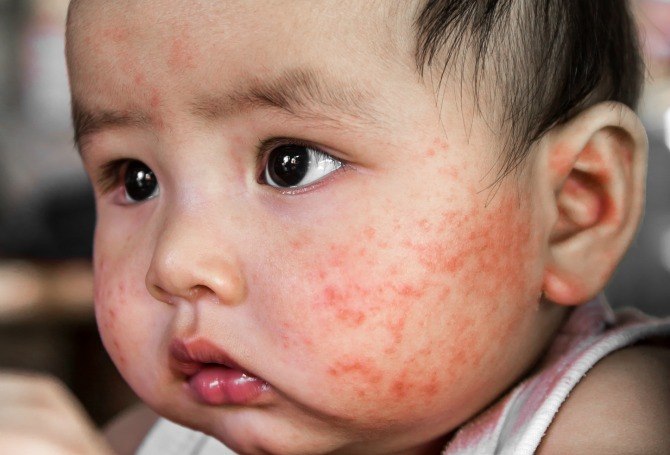 Is measles fatal? - Know the risk factors and complications