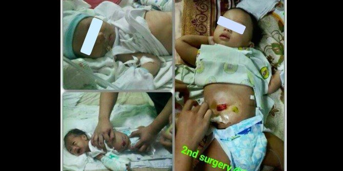 11-month-old boy with intestine sticking out of stomach needs surgery