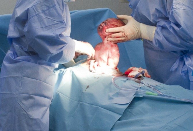 Caesarean section goes horribly wrong at a Cebu hospital