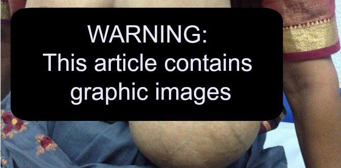 Woman grows a giant third breast after first pregnancy