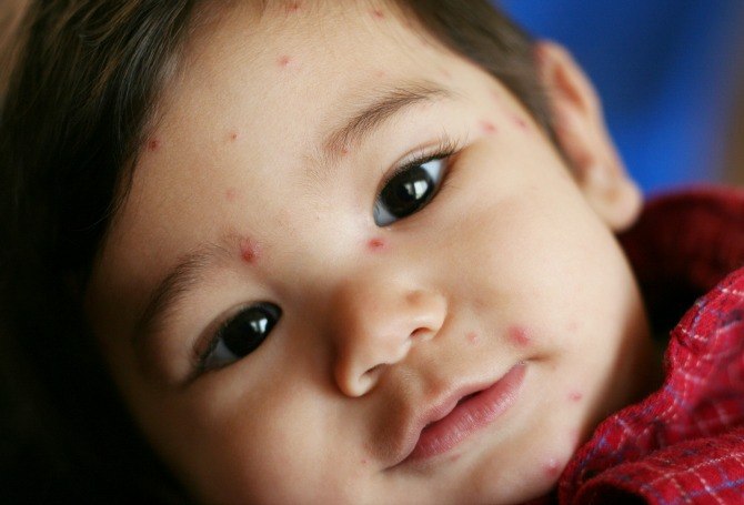 Does my child have chicken pox?