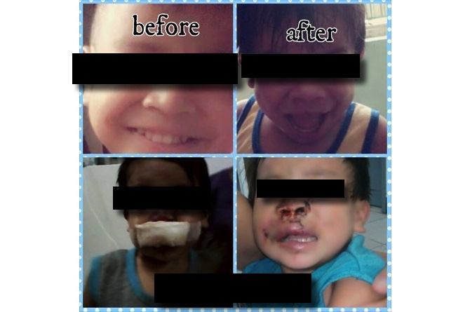 Abused 2-year-old in Surigao del Sur recovering from injuries