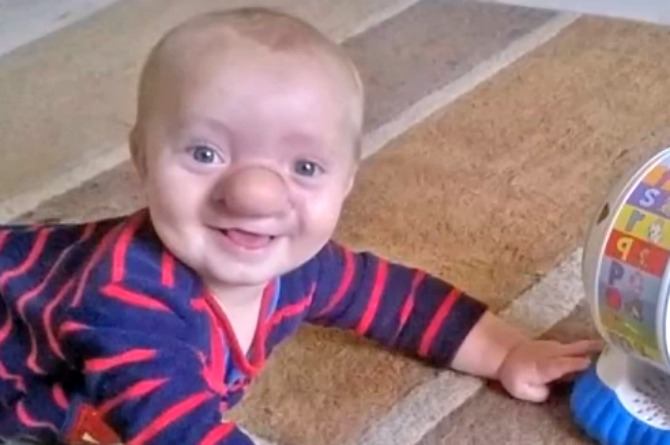 Meet the toddler whose brain grows through his nose
