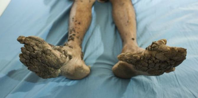 A rare illness is causing this boy’s skin to turn into stone