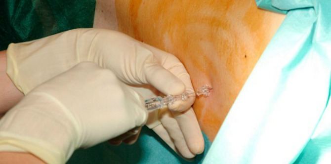 Epidural gone wrong paralyzed mother from the pelvis down