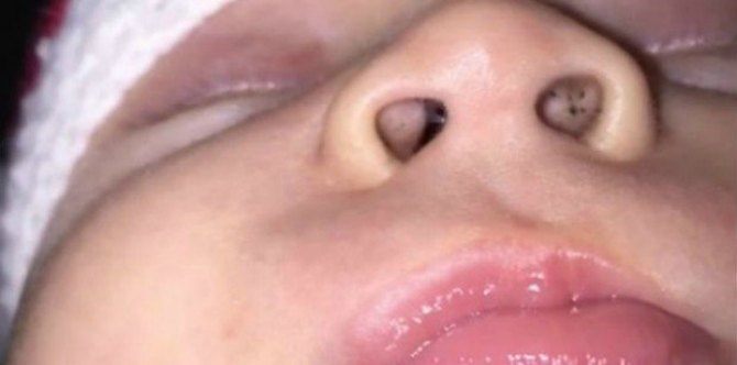 Find out what caused these strange black specks in baby’s nose