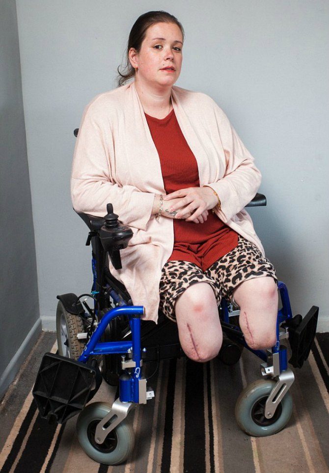 Mom Wakes Up After C-section to Find Both her Legs Amputated