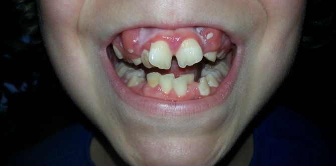Boy with rare teeth condition stops smiling after he was bullied