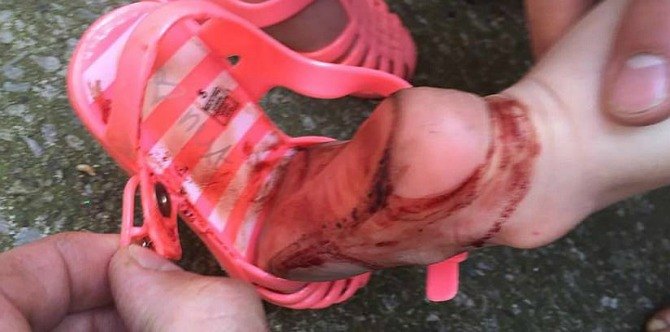 Mom outraged over what jelly sandals did to her daughter's feet