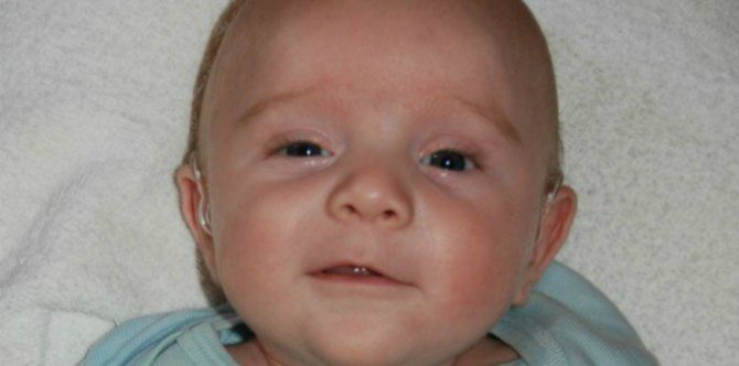 Common virus with no symptoms left baby disabled for life