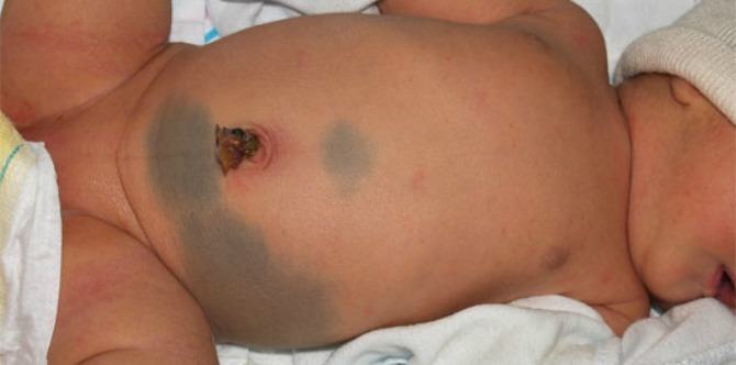 What causes a birthmark and when should I be worried?