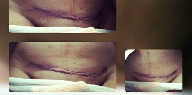 Mom's viral post slams notion that C-sections are "easy way out"