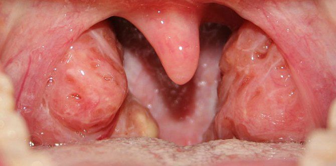 Having your appendix or tonsils removed increases pregnancy rates