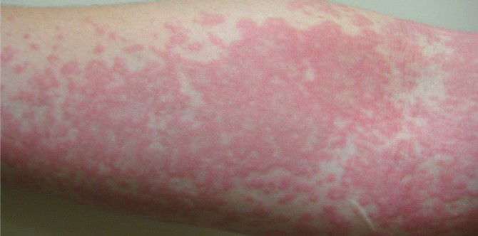 How to prevent allergy and asthma attacks for children