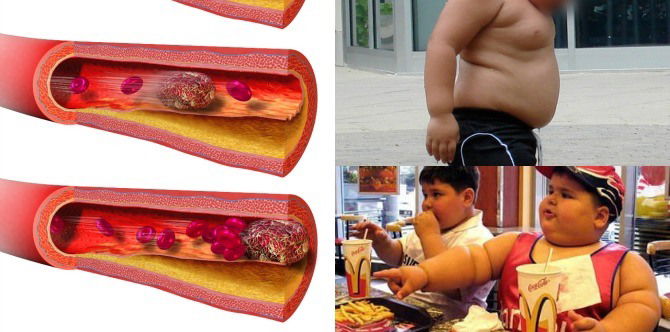 Obesity in children has been linked to the risk of blood clots in kids