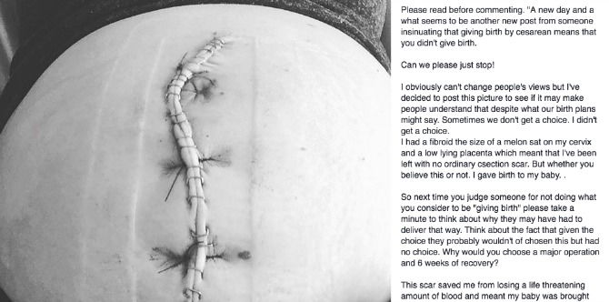 New mom shares a raw photo of her c-section scar to silence people from saying that it's "not really giving birth"