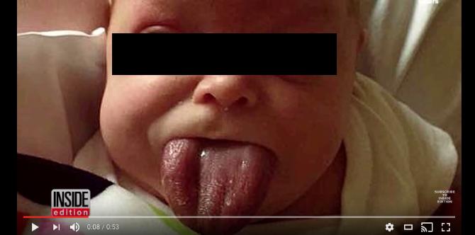 Baby born with abnormally large tongue finally able to smile