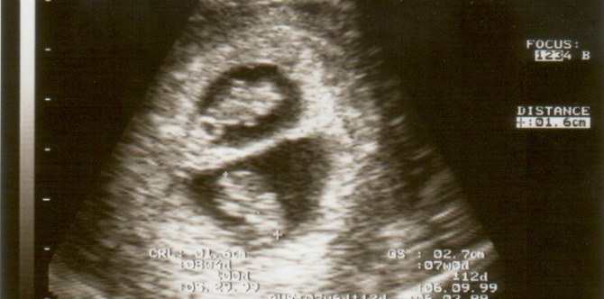 Woman becomes pregnant twice in 10 days because of a rare medical phenomenon