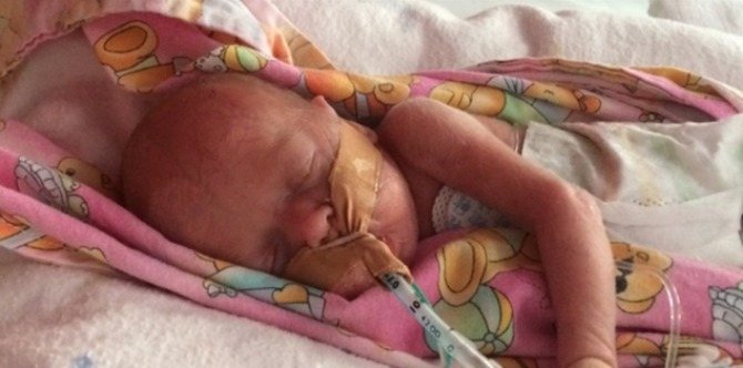 Premature baby girl survives meningitis, lung collapse, and a bleeding brain