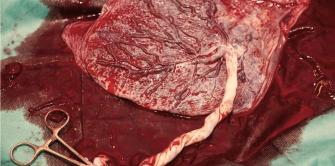 Eating placenta actually doesn't help with iron deficiency, says groundbreaking study